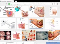 Cystoscopie un plaisir à subir
